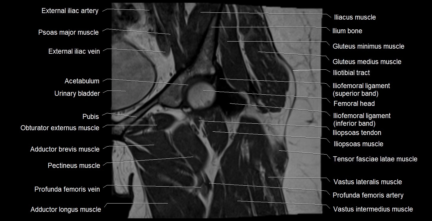 MRI Hip 3T coronal cross sectional anatomy image 23.webp